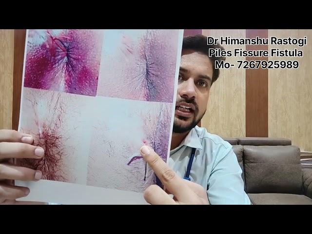 World Best Treatment For Fistula In Ano - Ksharsutra Vidhi. mo/wp 7267925989