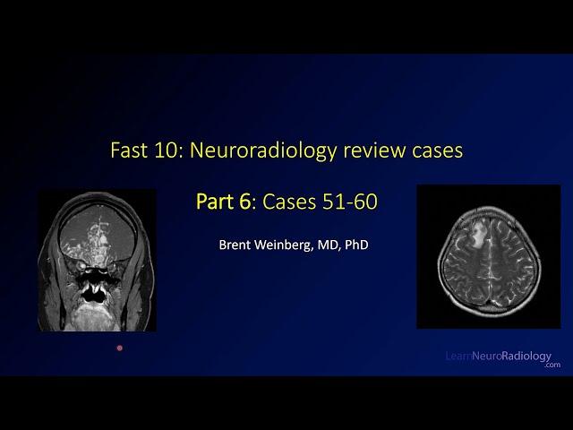 Fast 10: Neuroradiology high speed case review part 6 - Cases 51-60