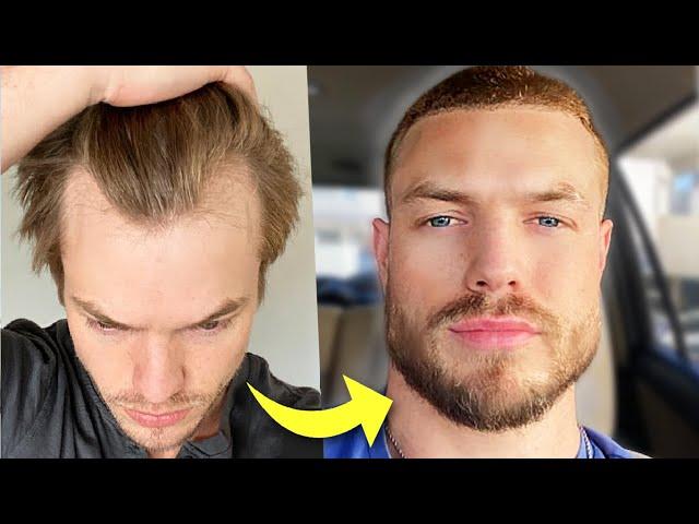 Shaving My Head 2 Years After Hair Transplant