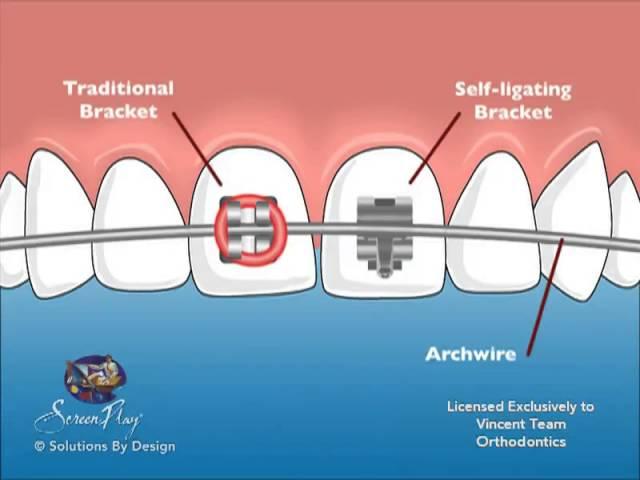 Vincent Team Orthodontics Self-Ligating Braces