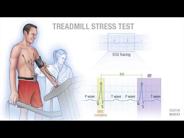 Mayo Clinic Minute: What is a cardiac stress test?