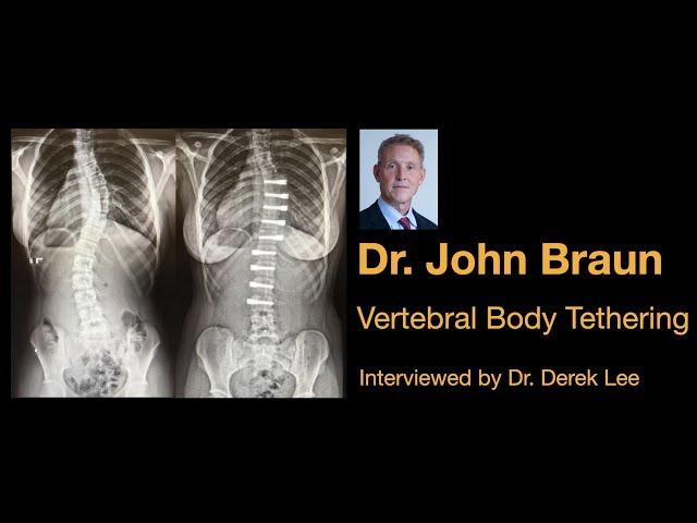 Dr. John Braun, Vertebral Body Tethering (VBT) Non-Fusion Scoliosis Surgery, by Dr. Derek Lee