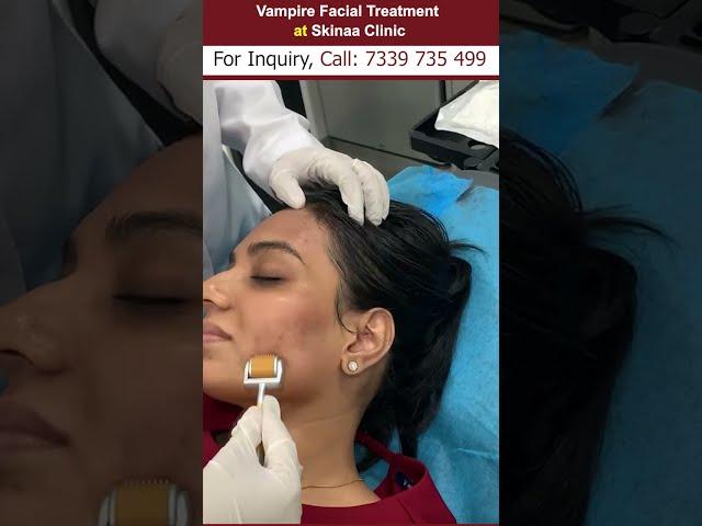 Vampire facial treatment at skinaa clinic
