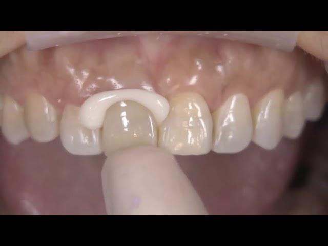 How to Use Kerr Nexus RMGI Resin Modified Glass Ionomer Cement