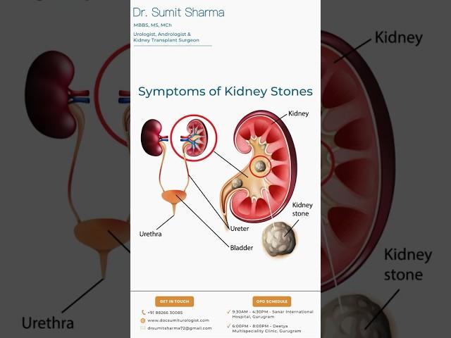 Symptoms of Kidney Stones | Dr. Sumit Sharma Urologist Gurgaon #kidneystone #urologist