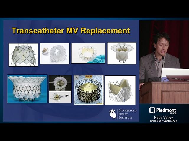 Transcatheter Mitral Valve Replacement: Repair, Replace or Do Nothing?