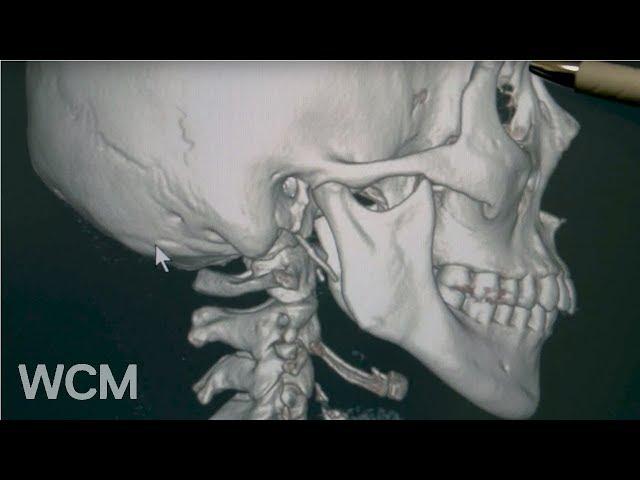 Facial Reconstruction | Dr. Anthony Sclafani | Weill Cornell Medicine