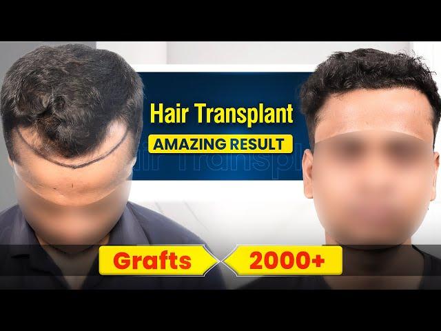 Best Hair Transplant in India | Amazing Hair Transplant Results & Cost of Hair Transplant in India