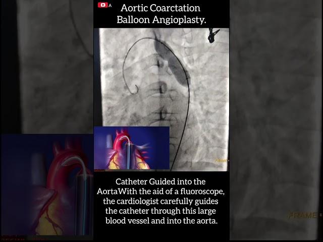 #cathlab #assessment #aorta #Angioplasty #nursing - Coarctation of the Aorta (CoA)