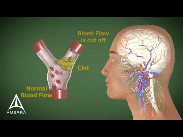 Stroke - 3D Medical Animation