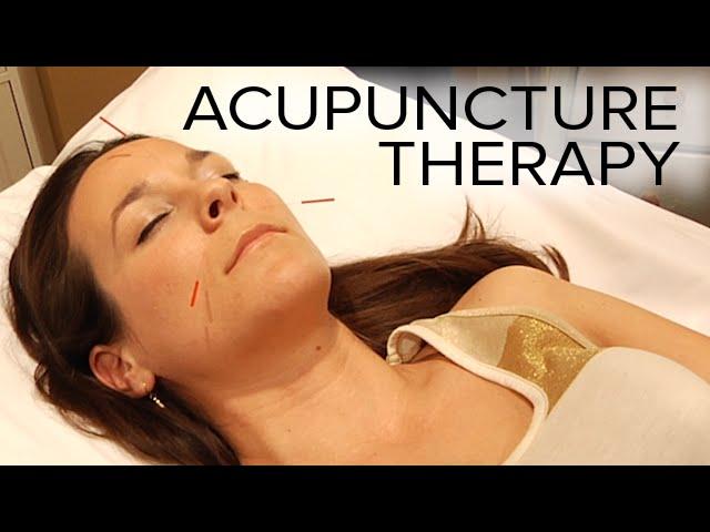 Acupuncture Therapy to Relieve Stress and Sinus Issues | ASMR Triggers