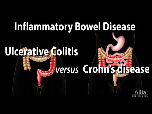 Ulcerative Colitis versus Crohn's Disease, Animation