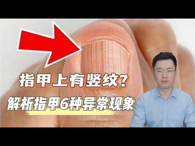 为什么指甲上有竖纹？解析关于指甲的6种常见现象！