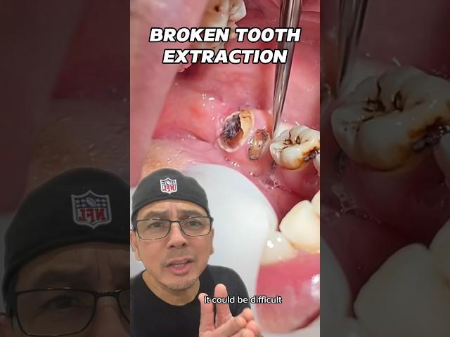 Broken Tooth & Root Tip Extraction (EASY) | In Office to Hands On Dental Training #shorts