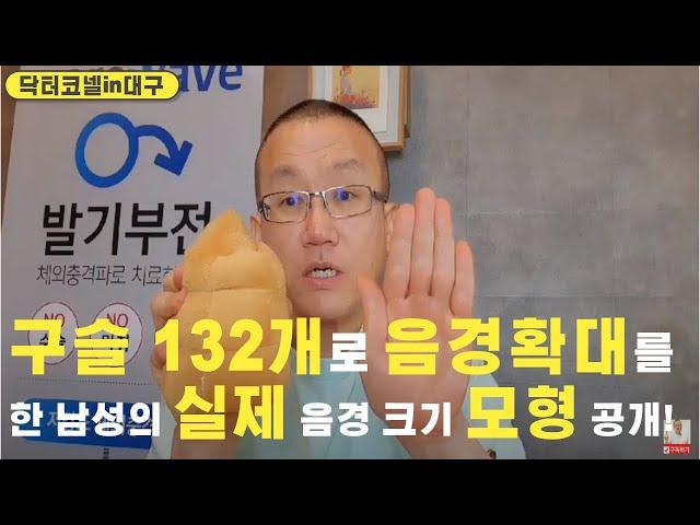 감당불가 음경확대, 구슬 132개로 음경확대를 한 남성의 역대급 실제 음경 크기 모형 최초 공개!/ 놀라운 음경 크기에 비뇨기과 의사마저 저절로 고개를 숙임 [음경확대 닥터코넬]