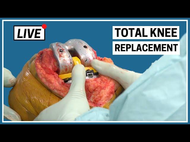 LIVE - Total Knee Replacement Surgery by Knee Expert