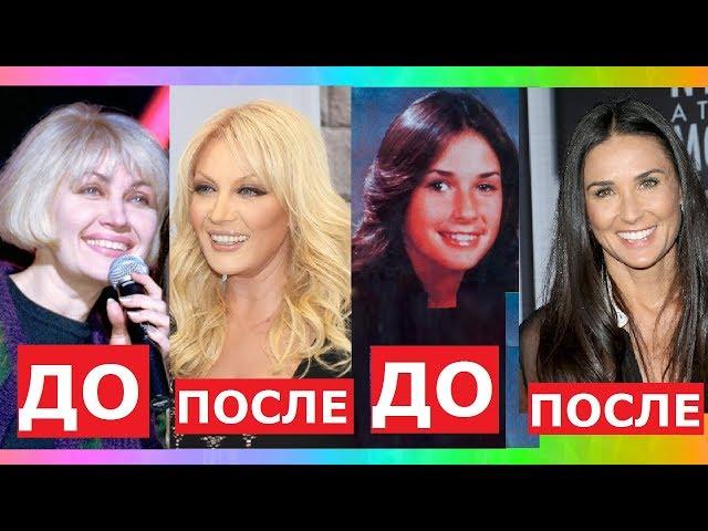 ЗВЁЗДЫ, которым ПЛАСТИКА пошла НА ПОЛЬЗУ!