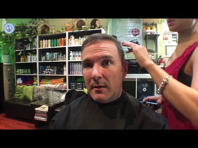 PRP For Hair Loss hair restoration hair transplant hair growth