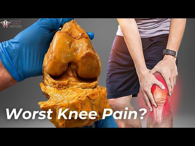 How Arthritis Destroys Your Knees