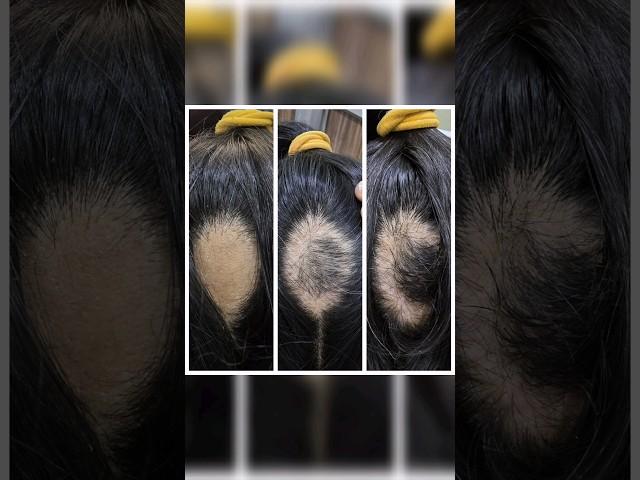 ALOPECIA ARETA #hair #aesthetic #regrowthhair #regeneration #skin #scalp #strong #viral #shorts