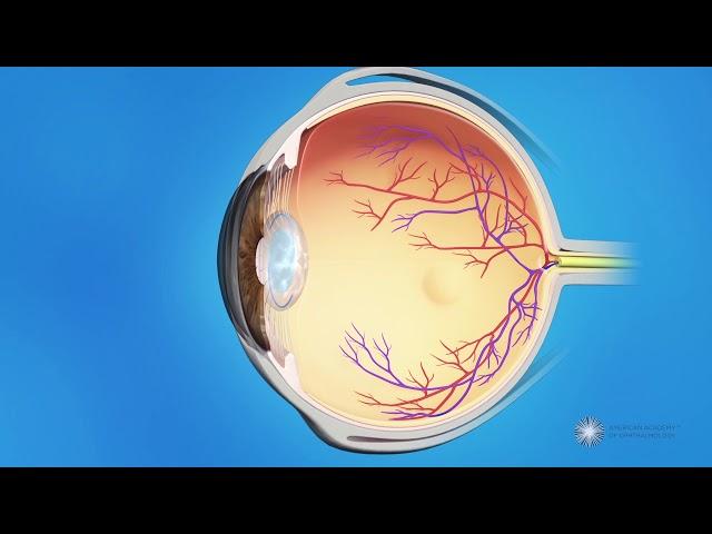 YAG Laser Capsulotomy for Secondary Cataracts