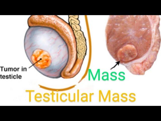 Testicular Mass | Mass in Testis | Testicle mass | Scrotal Mass | Lump on Ultrasound