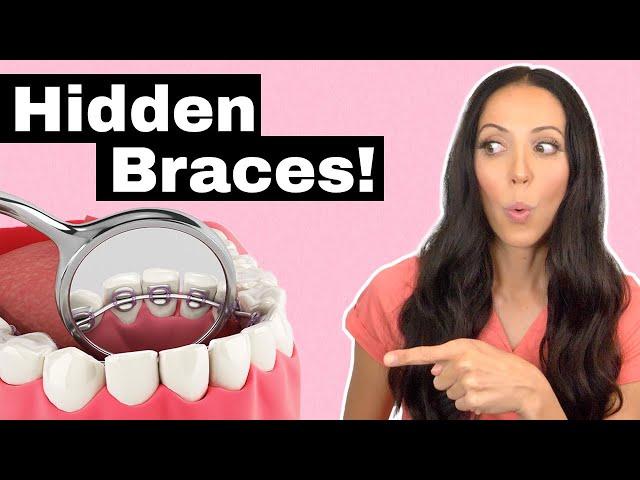 Dirty Secrets of Lingual Braces (The Braces You Can't See!)