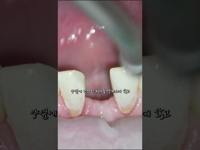 양 옆의 치아 삭제없이 공간 메꾸는 보철 '메릴랜드 브릿지'