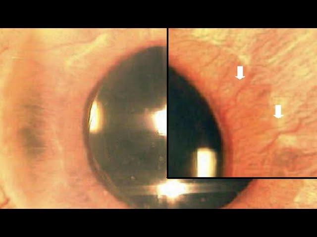 1 Slide in 5 Minutes: Neovascular Glaucoma (Malik Y.  Kahook, MD)