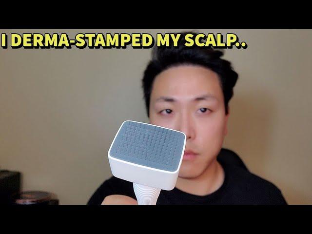 I USED A DERMA STAMP FOR HAIR GROWTH AND THIS IS WHAT I THOUGHT OF IT..