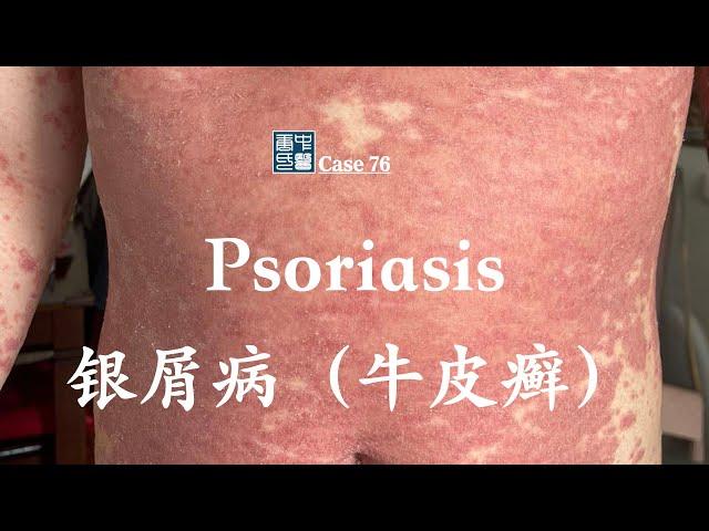 Tangs Clinical: Herbal Medicine works great for psoriasis with no prior immunosuppressants.