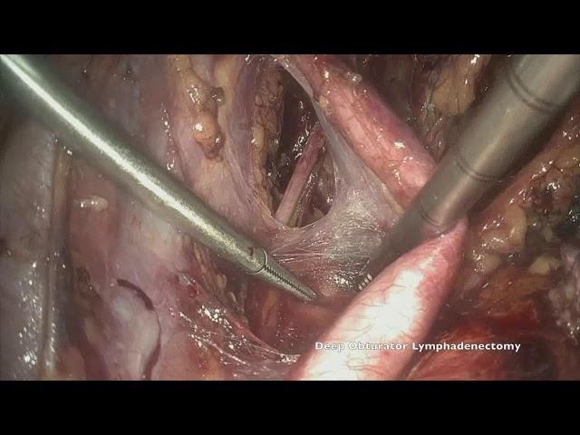 Laparoscopic sentinel lymph node mapping and lymphadenectomy by Dr. Marcello Ceccaroni, MD., Ph.D.