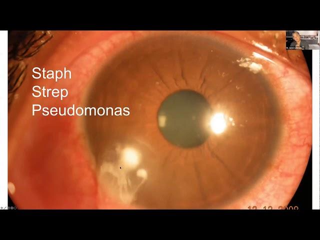 Lecture: Corneal Disease and Dystrophy Management