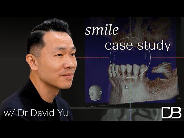 Smile Case Study - A fixed solution to dentures | Dental Boutique™