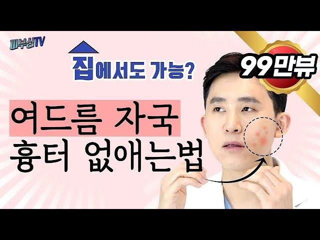 피부과 전문의가 알려주는 여드름자국 흉터 없애는 법  [피부과전문의 피부심]