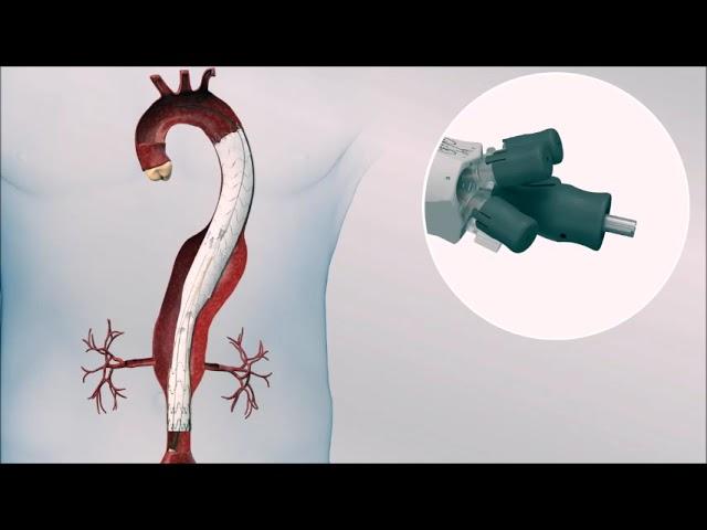 Endovascular TAAA treatment with E-nside performed by Dr. Lescan