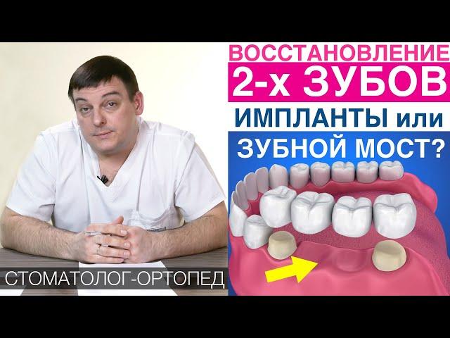 Восстановление 2-х зубов - зубной имплант или зубной мост?