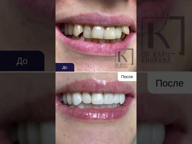 Керамические виниры E-Max. Новая улыбка без удаление зубов. #стоматолог #стоматология #виниры