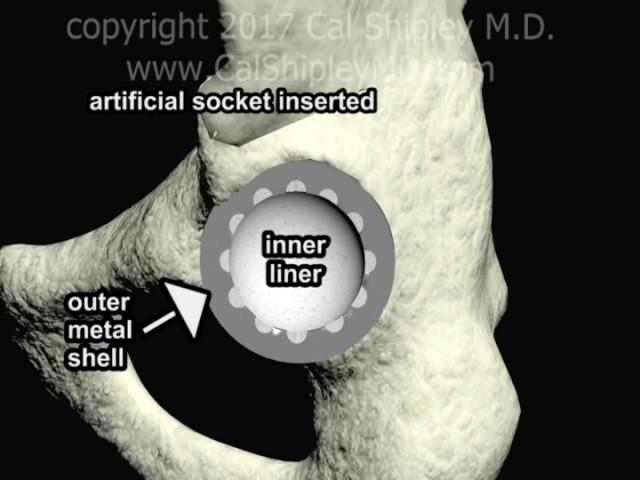 Hip Replacement Surgery - Animation by Cal Shipley, M.D.