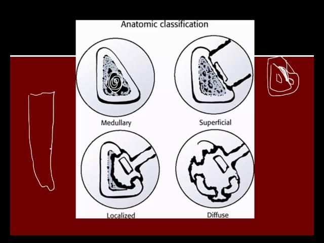 Chronic osteomyelitis
