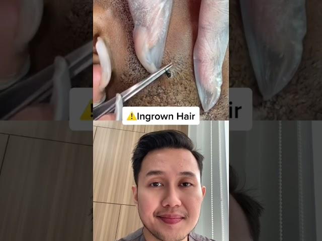 @dr.richardyl #ingrownhair #drrichardyl