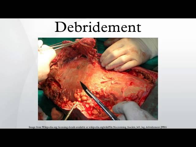 Debridement