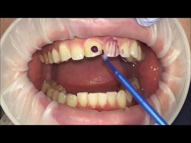 Veneers