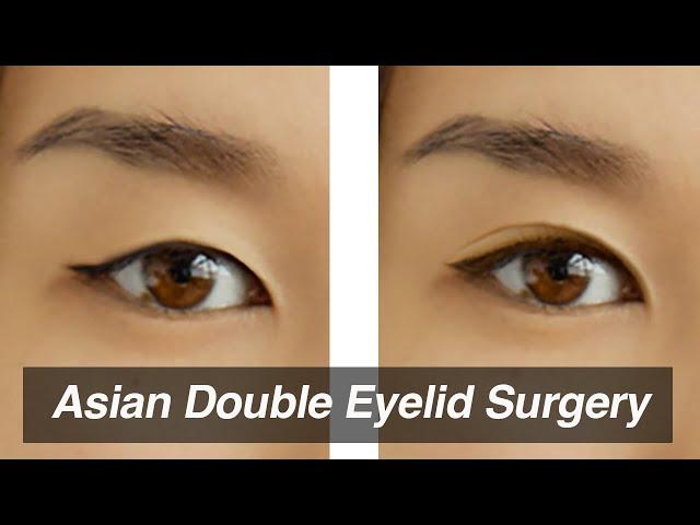 Asian Blepharoplasty (Monolid to Double Eyelid Surgery)