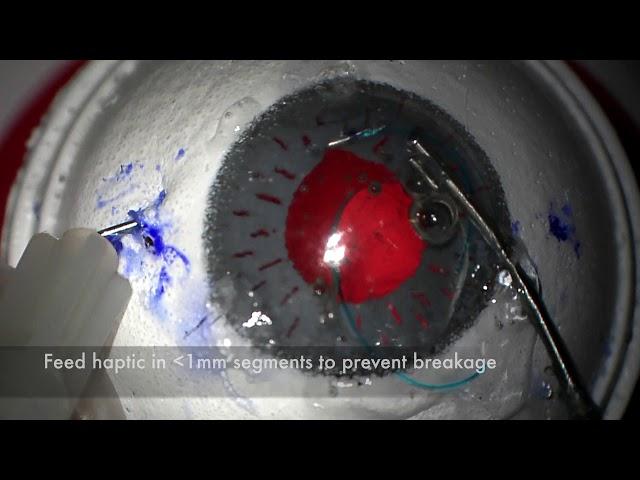 Yamane IOL Scleral Fixation Technique Demo on SimulEye Model