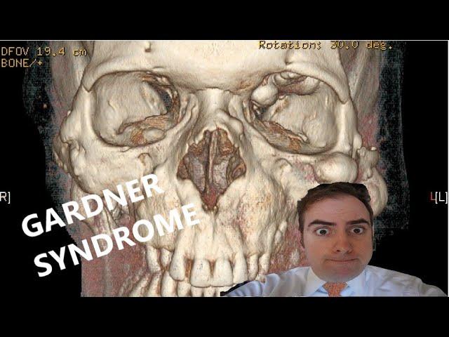 Syndrome Series: Gardner Syndrome