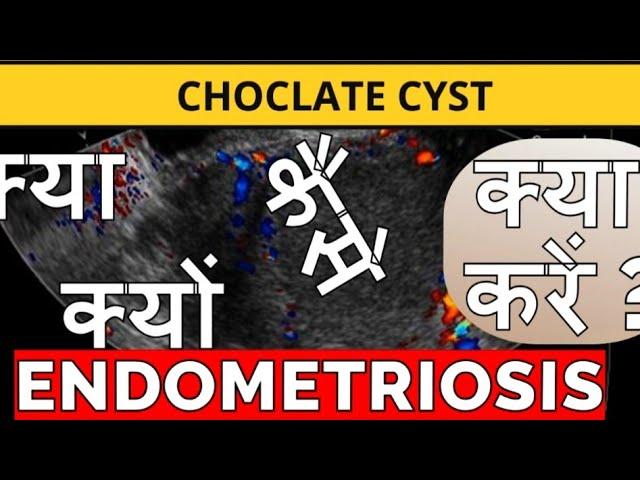 How to Manage endometriosis ?|#endometriosissymptoms |#endometriosisdiet |#endometriosistreatment