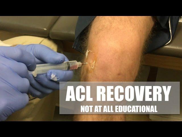 Torn ACL AGAIN from basketball! My 2 week recovery in under 3 minutes