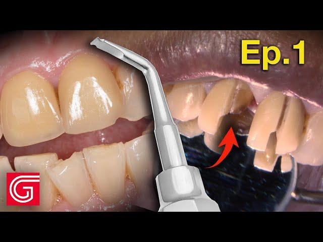 HOW TO Remove OLD ZIRCONIA Crowns on ANTERIOR Teeth | Ep 1