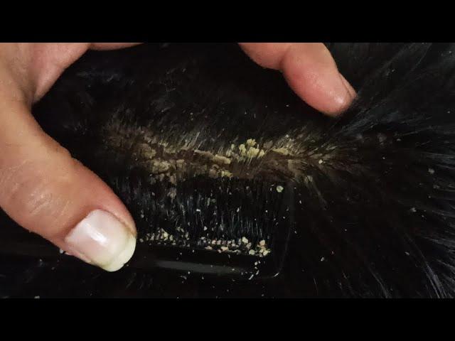 Scratching Dandruff Removing Psoriasis Flakes